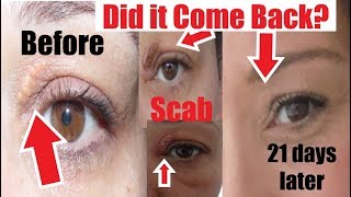 Has Xanthelasma Come Back Before amp After Xanthelasma Removal at Home I show My Scar after Removal [upl. by Lisha]