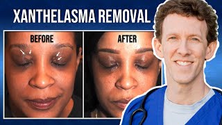 Removing Xanthelasma with Lasers  Thirzas Testimonial [upl. by Salta]