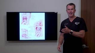 UPPP  Using thermal fusion amp trimming the uvula  soft palate to treat Snoring Sleep Apnea [upl. by Arielle]