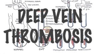 Deep Vein Thrombosis  Overview pathophysiology treatment complications [upl. by Thagard728]