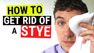 How to Get Rid of a Stye FAST  Chalazion VS Stye Treatment [upl. by Anehta25]