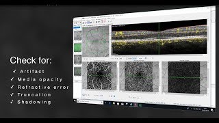 Systematic Interpretation of OCT Angiography Images [upl. by Winstonn]