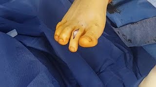 Surgical Correction of Hammertoe deformity [upl. by Kennan]