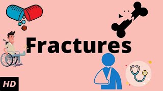 Fractures Causes Signs and Symptoms Diagnosis and Treatment [upl. by Menon948]