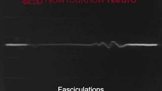 EMG Fasciculations [upl. by Eylrac]