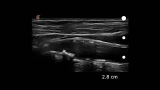 Image Interpretation Carotid Atherosclerosis [upl. by Nylsor]