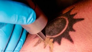 How Laser Tattoo Removal Works  Smarter Every Day 123 [upl. by Tattan200]