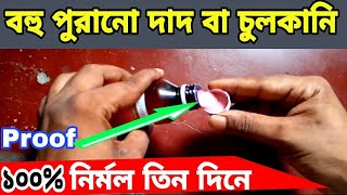 চুলকানি দূর করার সহজ উপায়  chulkani dur korar upay  chulkani  dad  fungus infection [upl. by Nerine]