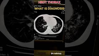 HRCT THORAX FINDINGS RADIOLOGY [upl. by Aisnetroh286]