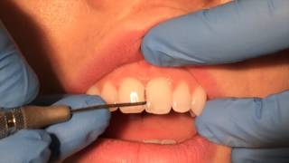 Periodontal Probing [upl. by Kamilah220]