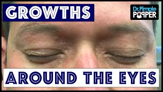 Removing Multiple Different Types of Growths around Eyes [upl. by Tecil231]