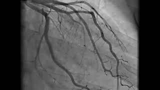 Coronary Angiography  NEJM [upl. by Nnairda]