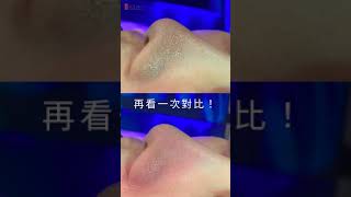 海菲秀（俗稱水飛梭）無痛清除粉刺 療程舒適安全！【晶華醫美診所】桃園海菲秀推薦 台北水飛梭推薦 桃園做臉 [upl. by Ayadahs]