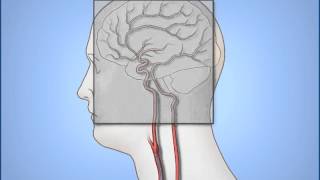 Carotid Duplex Exam [upl. by Storfer207]