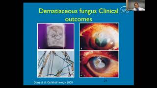 Lecture Fungal Keratitis [upl. by Joell]