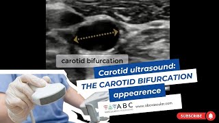 Internal Carotid Artery Route [upl. by Larena]