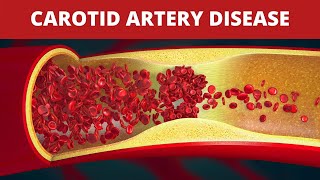 Internal Carotid Artery  Anatomy Branches amp Relations [upl. by Hummel20]