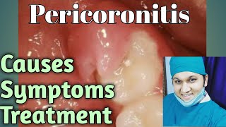 Pericoronitis Types Causes Signs Symptoms Treatments [upl. by Yelehsa]