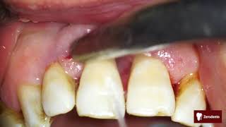 Advanced periodontal disease [upl. by Saxen]