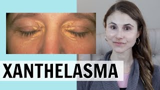 XANTHELASMA WHAT IT IS amp HOW IT IS TREATED DR DRAY [upl. by Adohr507]