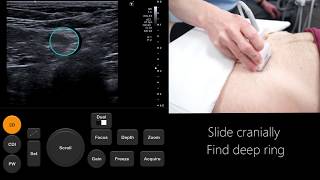 Ultrasound of the Lower Extremity Muscle Pathology [upl. by Regazzi]