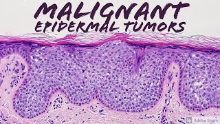 Malignant Epidermal Lesions amp Mimics 101 Carcinoma Basics  Dermatopathology Dermatology Pathology [upl. by Mainis]