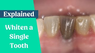 How to whiten a single dark tooth [upl. by Acisej]