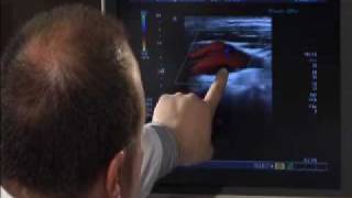 CAROTID ULTRASOUND THE CAROTID BIFURCATION [upl. by Ahsahs266]