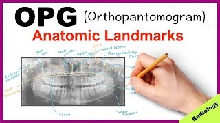 Orthopantomogram OPG Anatomical Landmarks  Radiology [upl. by Darren]