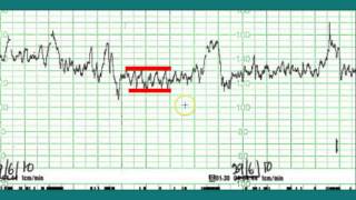 Ctg interpretation  Normal CTG [upl. by Nalro]