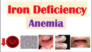 IronDeficiency Anemia Overview  Causes Pathophysiology Signs amp Symptoms Diagnosis Treatment [upl. by Aiouqahs]