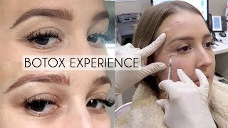 UNDER EYE BOTOX Experience amp Footage  BeforeAfter Cost Pain Bruising [upl. by Close]