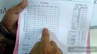 How to interpret a Pure Tone Audiogram PTA [upl. by Ailimat]