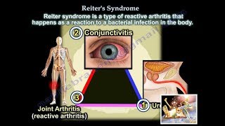 Reiters Syndrome Reactive Arthritis  Everything You Need To Know  Dr Nabil Ebraheim [upl. by Llertnod]