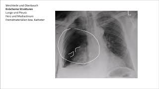 Röntgen Thorax Befundung [upl. by Harrod]