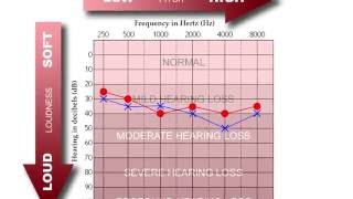 How to Read an Audiogram [upl. by Raphael483]