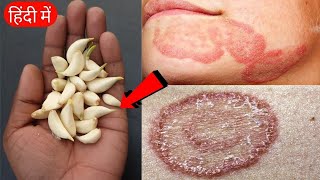 3 दिन  पुराने से पुराने दाद खाज खुजली को दूर करने का सबसे सफल उपाय  Ringworm Treatment Naturally [upl. by Mindy]