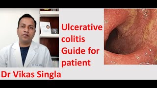 Ulcerative colitis Treatment and Symptoms अल्सरेटिव कोलाइटिस In Hindi Dr Vikas Singla [upl. by Bottali602]