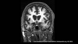 Huntingtons Disease [upl. by Mraz]