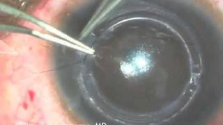 Intacs Insertion for Keratoconus [upl. by Suneya]