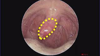 Traumatized Uvula [upl. by Lynnea]