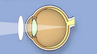 Retinoscopy of the eye Ophthalmology [upl. by Levitt]