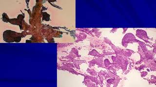 Thyroid Cytology II Cases [upl. by Dralliw]