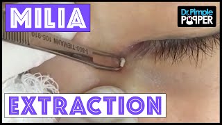 Milium Extraction from a Very Delicate Inner Eye Area [upl. by Hajin993]