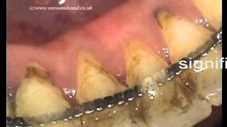 Non Surgical Periodontal Treatment [upl. by Behnken]