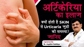 Urticaria Hives Causes Symptoms amp Treatment  In Hindi   Dr Jagdish Sakhiya Skin Clinic [upl. by Ahsiekal]