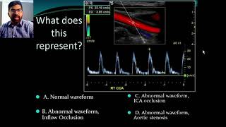 Carotid Protocol Esther Collado RN RVI [upl. by Anselm]