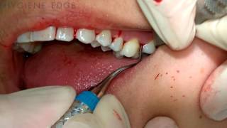 Gracey Instrumentation During Periodontal Therapy [upl. by Nicki]