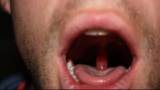 swollen throat clinical case answer and discussion [upl. by Donahue]