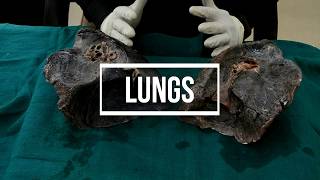 Lungs  gross anatomy [upl. by Emelia]